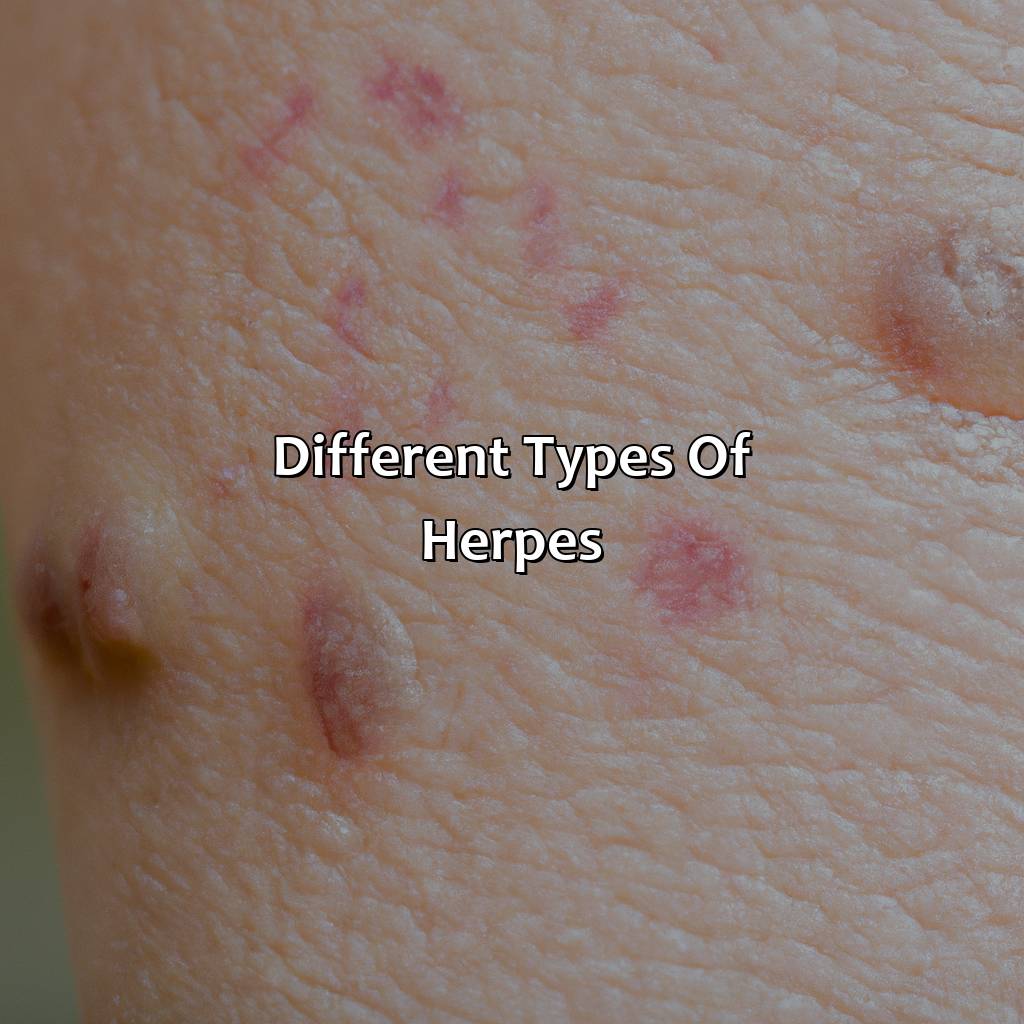 Different Types Of Herpes  - What Color Are Herpes, 