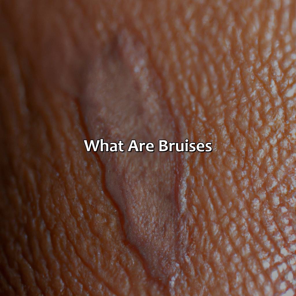 What Are Bruises?  - What Color Covers Bruises, 